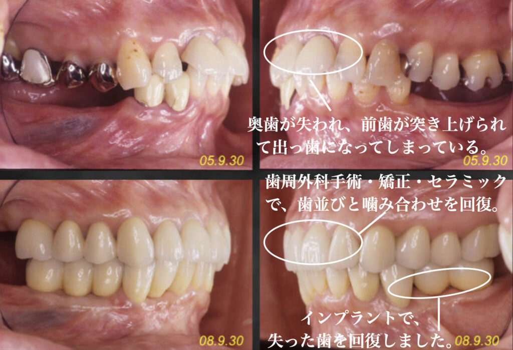 山口県下関市おおむら歯科医院で、歯周病の患者に対して、歯周外科、インプラント、矯正、セラミックを用いた審美歯科治療を行った写真。